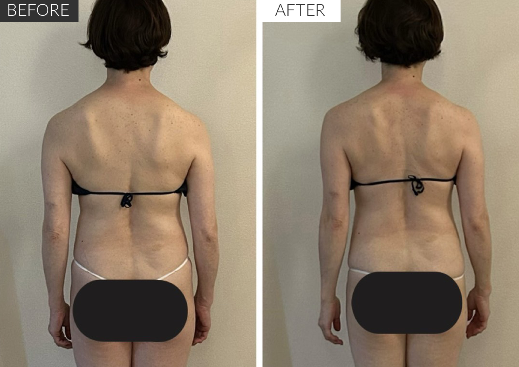 BODY LINE SCULPTING ビフォアアフター